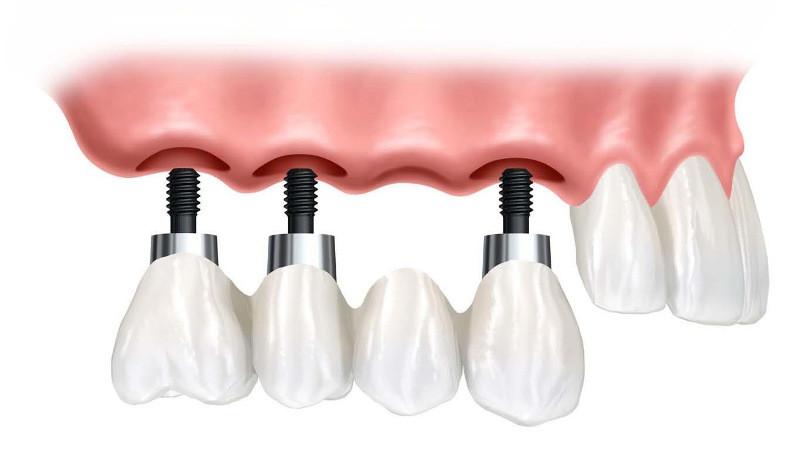 (P) 3 intrebari fundamentale ale caror raspunsuri conteaza in cazul unui implant dentar