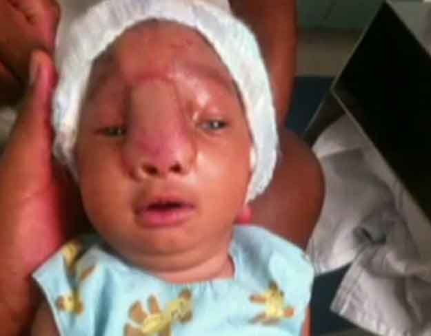 Copilul asta s-a născut cu creierul în afara craniului! Cum arata acum, după o operație de șase ore care i-a salvat viața!