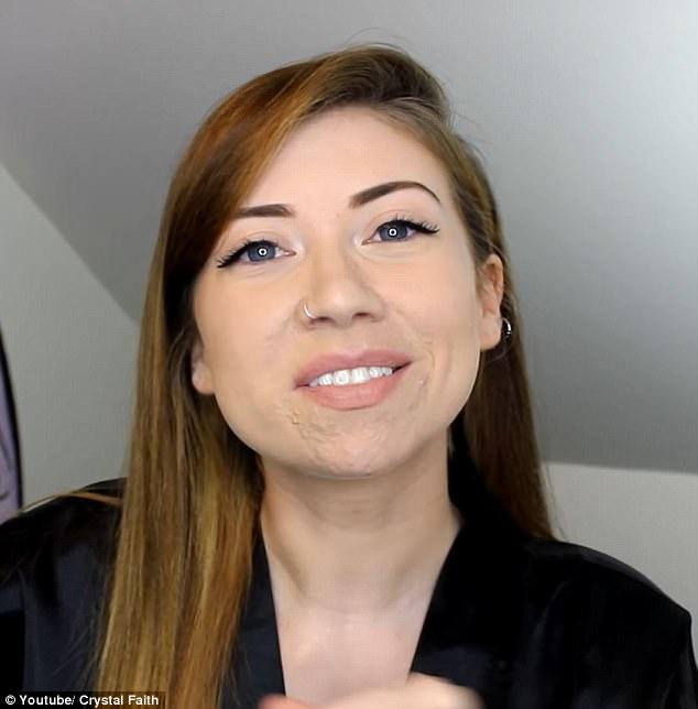 Suferea de acnee severa si ii era rusine sa iasa din casa! Ce a decis tanara - Rezultatul este uimitor 459317