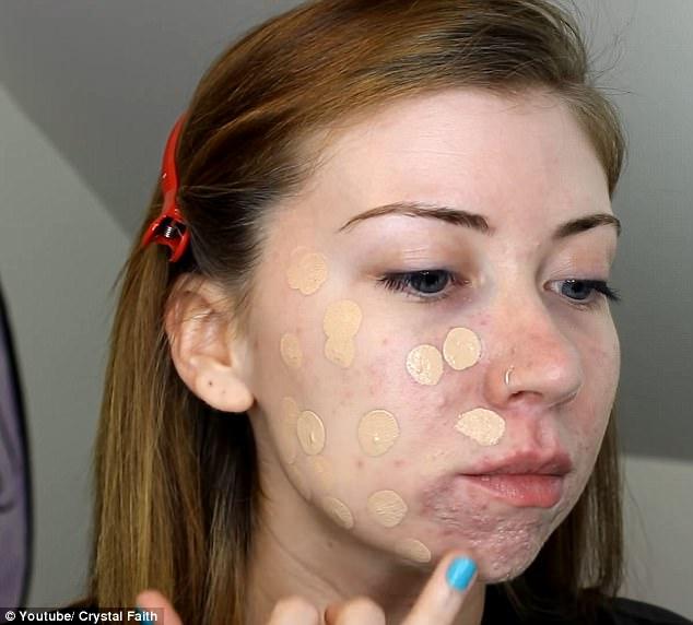 Suferea de acnee severa si ii era rusine sa iasa din casa! Ce a decis tanara - Rezultatul este uimitor 459318