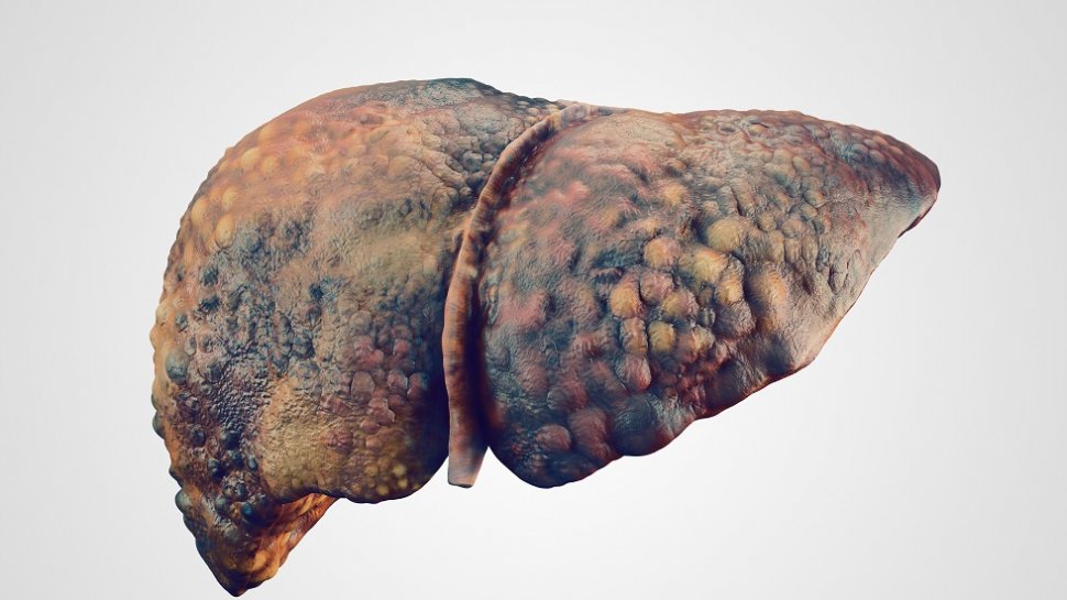 Așa arată ficatul unui bolnav de cancer la ficat. Cum poți depista la timp această boală