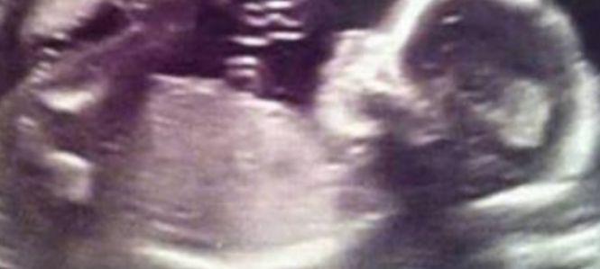 O mămică i-a arătat unei prietene ecografia fetiței sale. Detaliul pe care l-a observat a făcut-o să plângă: „Poate i-a fost teamă să vină pe lume” 471627