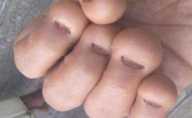 Acest bărbat și-a ros unghiile. La scurt timp după aceea era mort. Este de necrezut ce i s-a întâmplat  477635