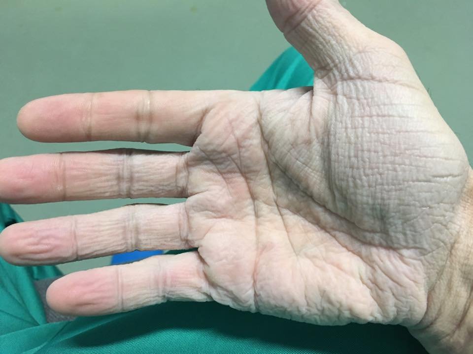 Cum arată mâna unui medic din România după 12 ore de operații la 30 de grade! ”A ajuns o batjocură să…”