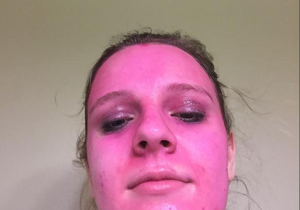 Și-a aplicat pe față o vopsea, despre care citise că poate fi înlăturată prin spălare. Doar că adevărul a fost altul. Cum arată acum femeia (FOTO) 479446