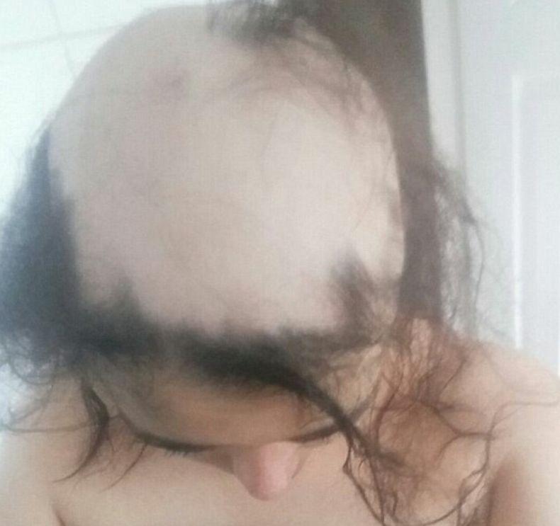 Într-o zi a observat că a început să-i cadă părul foarte tare. Iar în trei luni, avea deja porțiuni mari de păr lipsă. Când și-a dat seama care este motivul, a luat imediat măsuri. Atenție! Se poate întâmpla oricui 479782