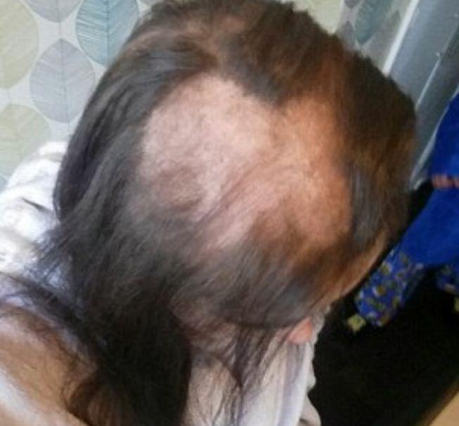 Într-o zi a observat că a început să-i cadă părul foarte tare. Iar în trei luni, avea deja porțiuni mari de păr lipsă. Când și-a dat seama care este motivul, a luat imediat măsuri. Atenție! Se poate întâmpla oricui 479783