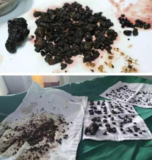 Timp de opt ani a sărit peste micul dejun. Când femeia a ajuns la spital cu dureri cumplite de stomac, medicii au dus-o imediat în sala de operație. Este cumplit ce au găsit în burta femeii (FOTO) 489187