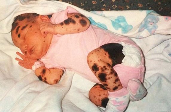 S-a născut cu o boală rară de piele și i se spunea &quot;Dalmațianca&quot;. Cum arată tânăra astăzi, la 20 ani - FOTO