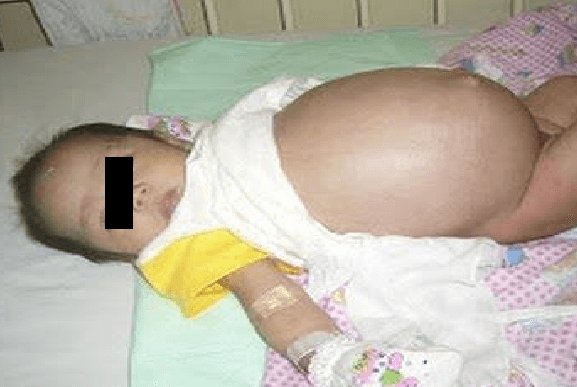 S-a născut cu bine, dar medicii au văzut că avea stomacul umflat. Ce au scos din burtica bebelușului