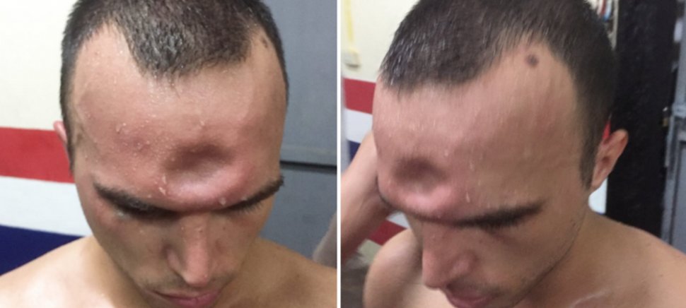 Un luptător de Muay Thai s-a ales cu o gaură în craniu. Cum arată după operație