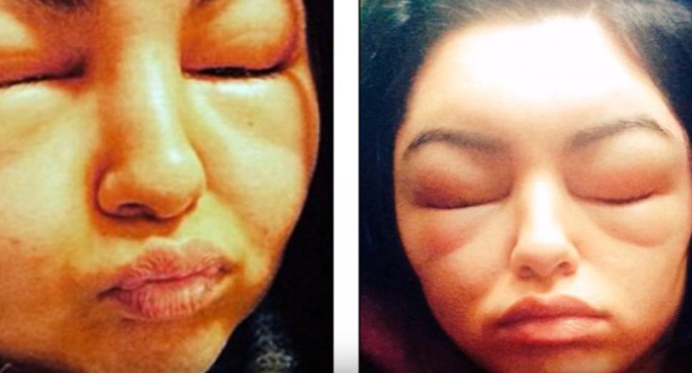 S-a ales cu faţa umflată şi cu orbire temporară după ce a făcut o greşeală pe care multe femei o fac 504950