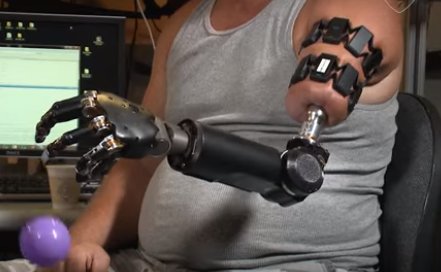 El este primul om care are un braț robotizat pe care îl controlează cu ajutorul creierului 