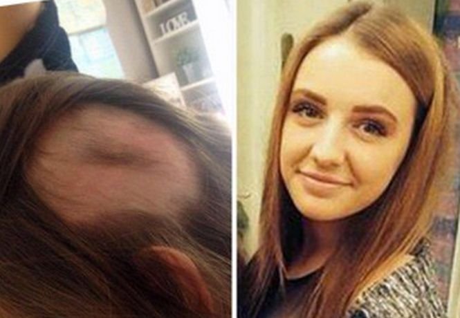 Afecțiunea de care suferă o tânără căreia i-a căzut tot părul la doar 19 ani