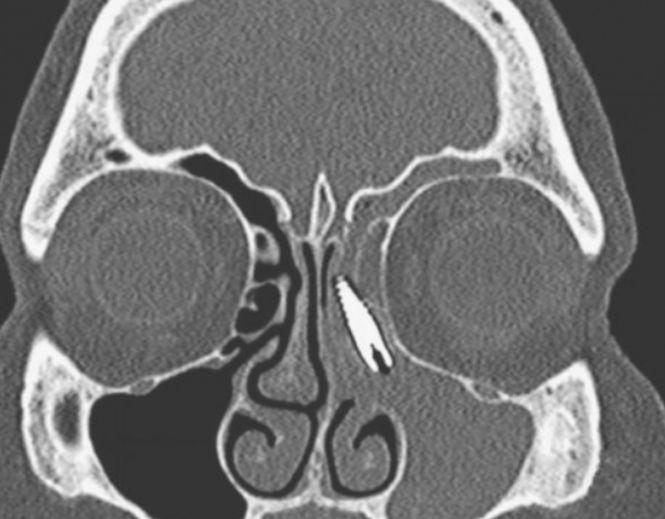 Doi ani a avut dureri crunte în nas. Nu a mai suportat și a mers la spital. Ce avea acolo i-a speriat pe doctori 514933
