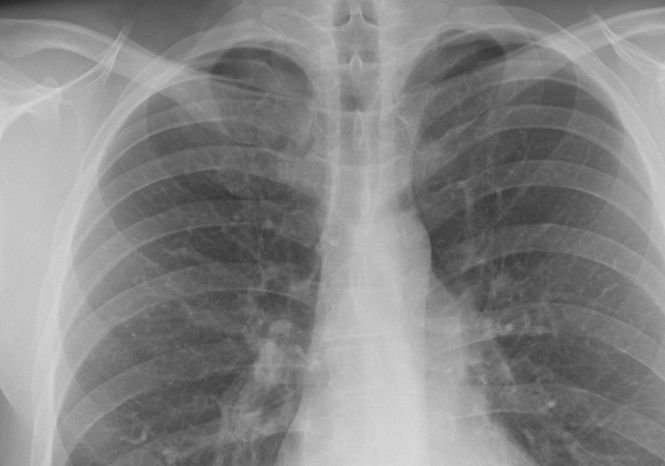 Radiografii pulmonare gratuite pentru bucureşteni