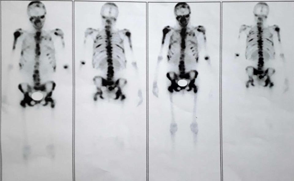 Apelul disperat al unei fete de 23 de ani, din Năvodari, care se luptă cu o boală cumplită: „Ajutor! Vreau să trăiesc!” 530308