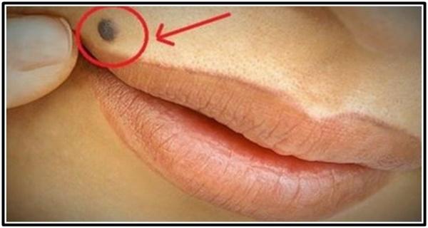 Adevărul despre alunițe, spus de un celebru medic român. Ce se întâmplă dacă le îndepărtezi chirurgical 530856