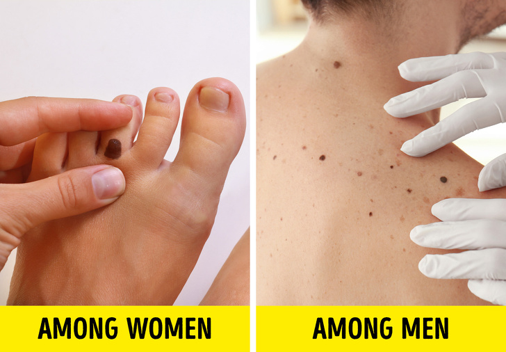 In ce zone ale corpului apare cel mai des cancerul de piele