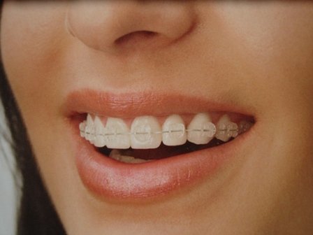 Aparatul ortodontic: o necesitate pentru unii, un moft pentru alții
