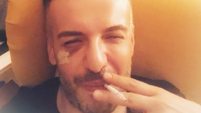 Răzvan Ciobanu, bătut cu bestialitate de iubit: „Mi-a spart obrazul cu o bară de metal”