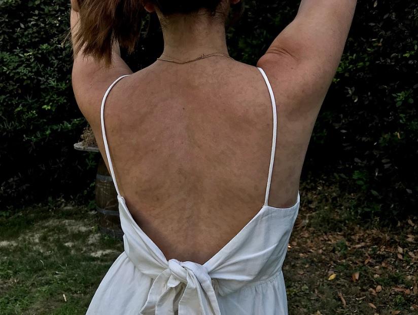 Un medicament banal i-a provocat arsuri pe 90 la sută din piele. Drama prin care a trecut tânăra: „Nimeni nu mi-a spus ce ar putea face această boală corpului” 558135