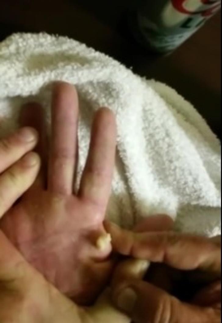 Prietenul lor dormea, iar ei i-au spart chistul de pe mână! S-au crucit când au văzut ce a ieșit de acolo - FOTO 565140