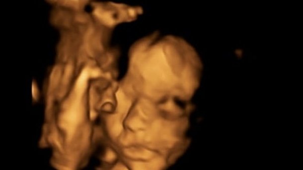 S-a dus să își facă o ecografie în cea de-a douăzecea săptămână de sarcină, iar medicii au sfătuit-o să avorteze. „E cel mai urât coșmar pentru orice mamă”. A refuzat, iar acum urmează să aducă pe lume un copil sănătos: „E ca o minune”