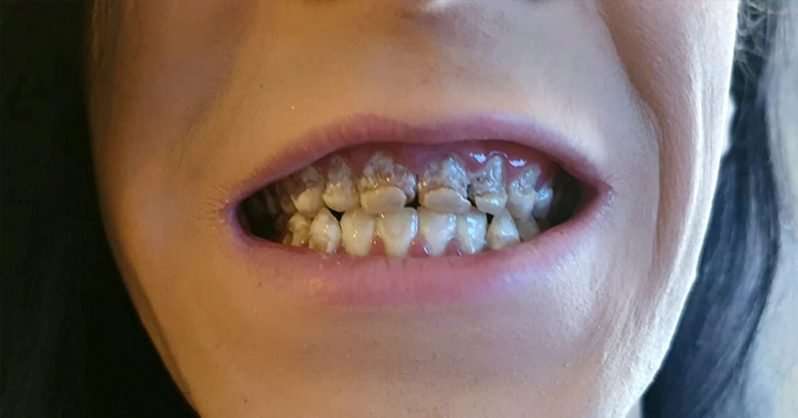 Ani la rând a avut acest obicei și a ajuns să arate așa! Dentistul s-a îngrozit când l-a văzut: ”Mi-a spus că este unul dintre cele mai grave cazuri pe care le-a văzut vreodată!”