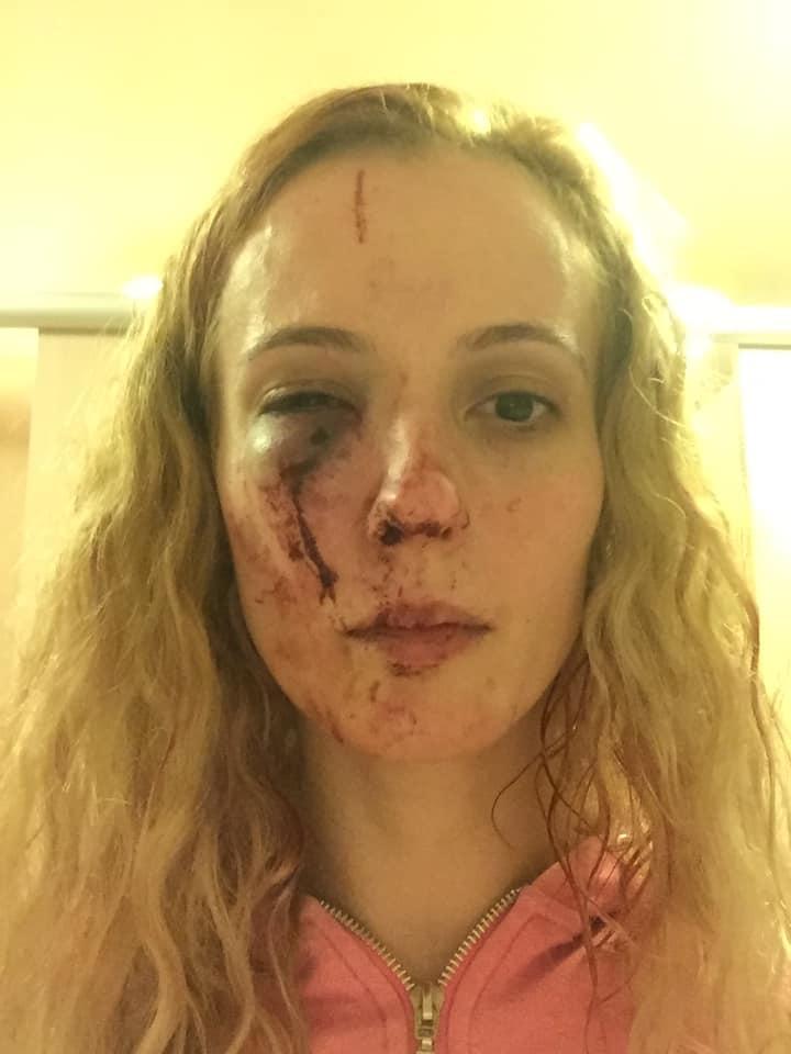 Anca este românca desfigurată de un grup de adolescenți din Marea Britanie. "Au luat foc și au sărit pe mine" FOTO 583774