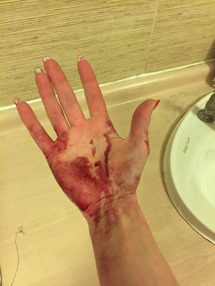 Anca este românca desfigurată de un grup de adolescenți din Marea Britanie. "Au luat foc și au sărit pe mine" FOTO 583775