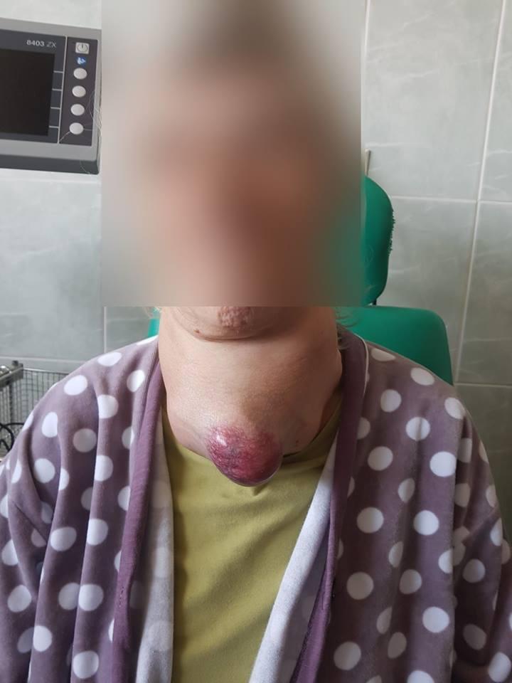 E fumătoare, avea o gușă voluminoasă și răgușise, de-abia mai vorbea. Medicii de la Spitalul Universitar București s-au uitat imediat în gâtul femeii. Era uriașă! A fost nevoie de 11 doctori de la patru specializări FOTO cu IMPACT EMOȚIONAL 587597