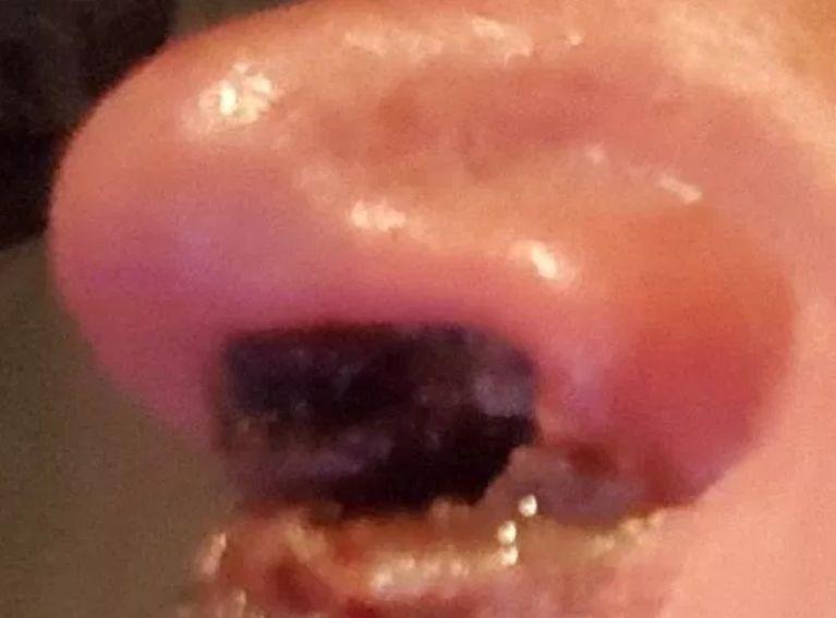 Acest bărbat a consumat cocaină timp de 25 de ani. E absolut șocant ce i-au făcut drogurile. Începuse să-i pice bucăți din nas! 588335