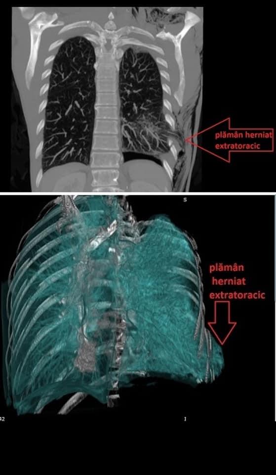 Medicii de la Spitalul Universitar din București au intrat în operație. Când au văzut cine era pe masă, au rămas surprinși. "Practic îi ieșise plâmânul afară!" 592825