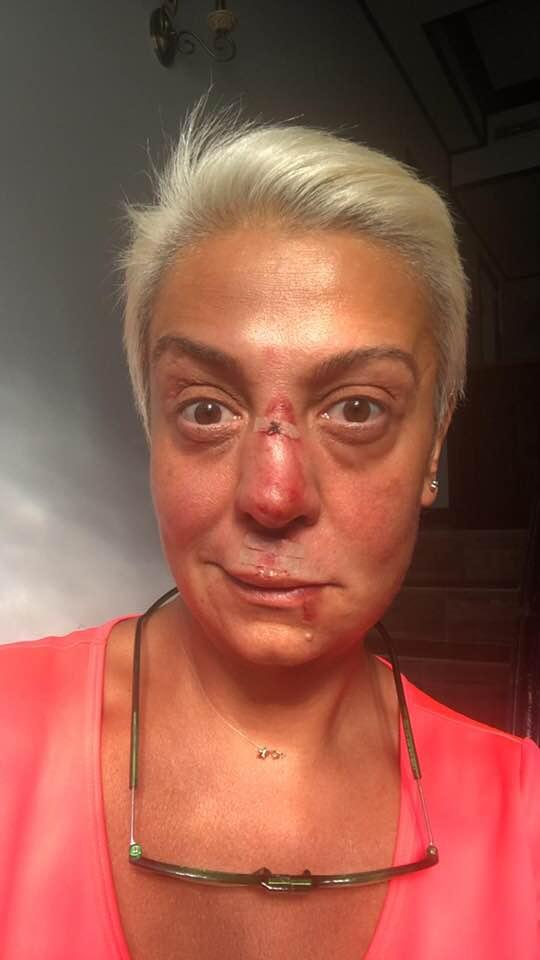 Monica Anghel, desfigurată! Cum arată artista după ce a picat de pe cal - FOTO 611576