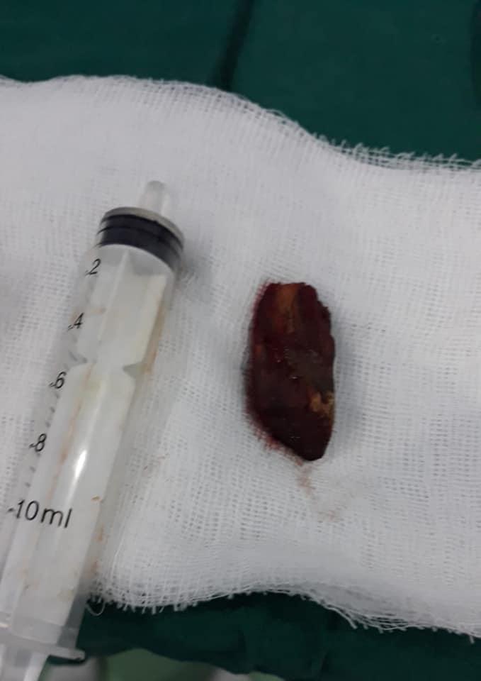 Bărbatul a fost agresat de un vecin. La doi ani de la incident a ajuns de urgență la un spital din București. Medicii au văzut că se întâmpla ceva ciudat cu un orificiu din obraz. La o analiză amănunțită, au înțeles cruntul adevăr. „Rar vezi așa ceva!” 616791