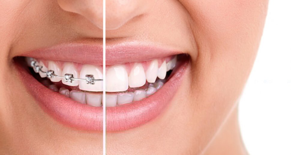 Alege un aparat dentar de calitate! Iata cateva motive convingatoare! 
