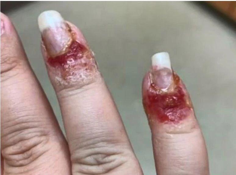 A vrut o manichiură de vis, dar s-a ales cu un coșmar: degete umflate și pline de puroi. Cum arată acum unghiile femeii. IMAGINI șocante! 627023