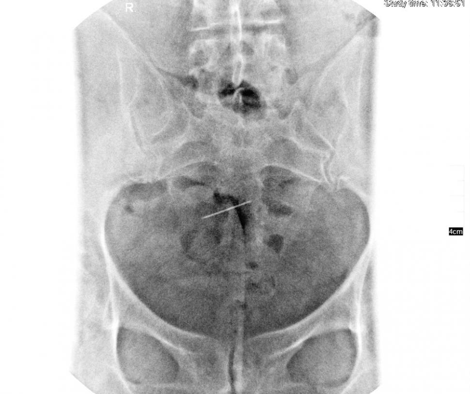 Femeia din Iași se simțea rău și s-a dus la medic. Specialistul a încremenit când a văzut ce apare pe radiografie. „Dumnezeule, e de 30 de ani acolo!” (FOTO) 627003