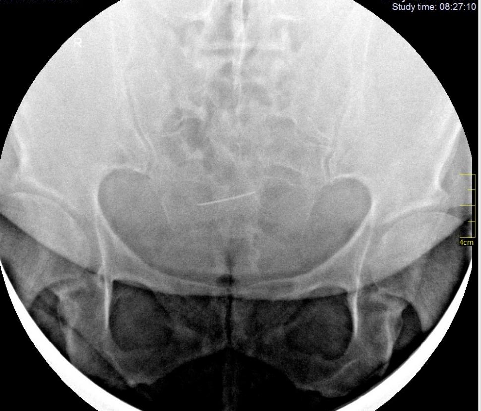 Femeia din Iași se simțea rău și s-a dus la medic. Specialistul a încremenit când a văzut ce apare pe radiografie. „Dumnezeule, e de 30 de ani acolo!” (FOTO) 627004