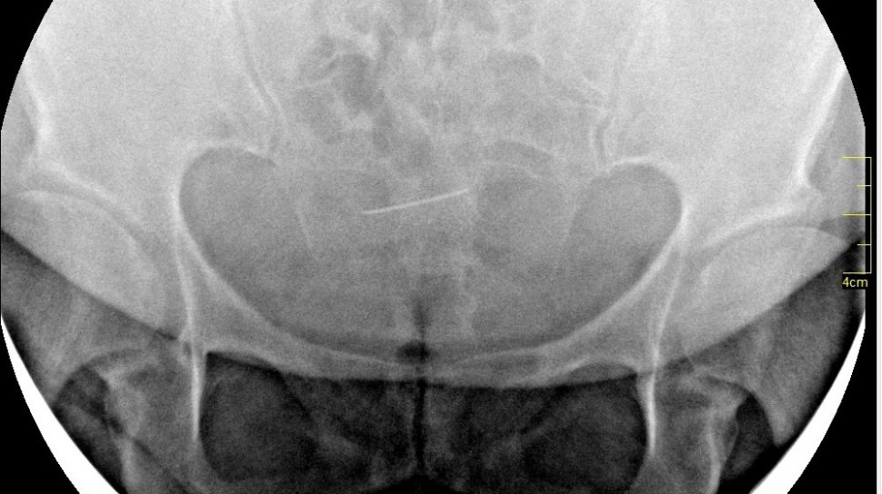Femeia din Iași se simțea rău și s-a dus la medic. Specialistul a încremenit când a văzut ce apare pe radiografie. „Dumnezeule, e de 30 de ani acolo!” (FOTO)