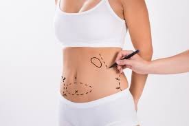 Abdominoplastia, interventia estetica prin care vei avea un abdomen plat