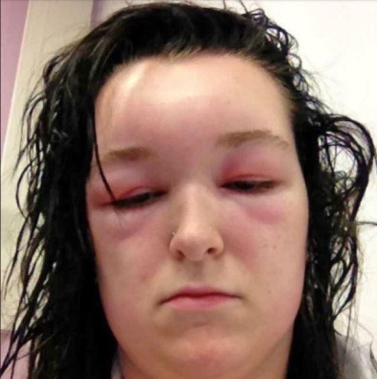 Vopseaua de păr aproape a ucis-o! Era atât de deformată încât arăta precum „un extraterestru”. Medicii au fost la un pas să o radă în cap, doar ca să o scape de reacția alergică! 629599