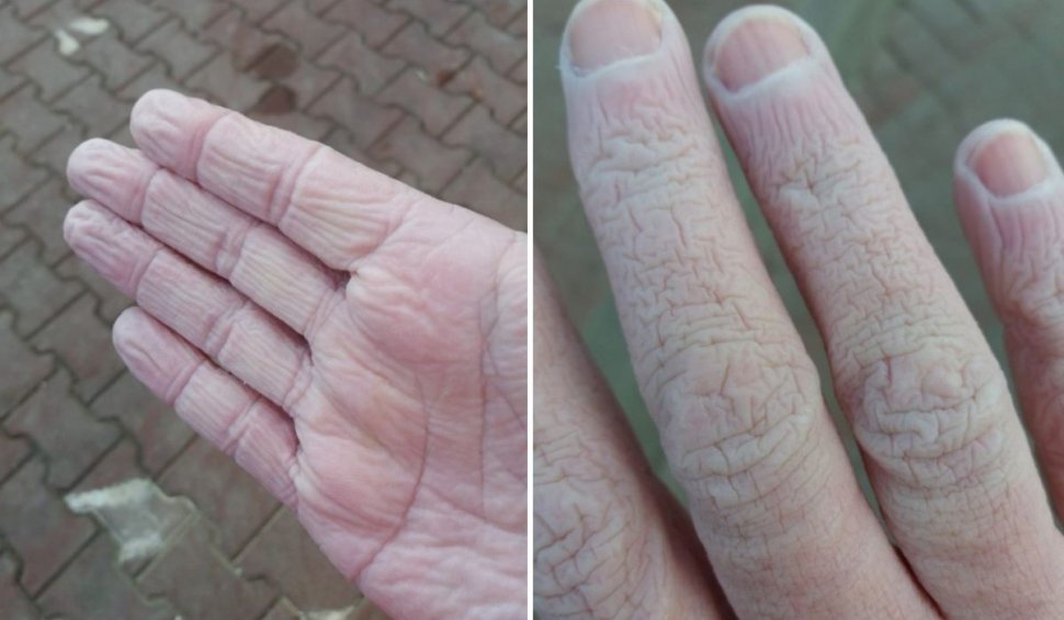 Cum arată mâinile unui cadru medical de la Suceava după 12 ore de muncă