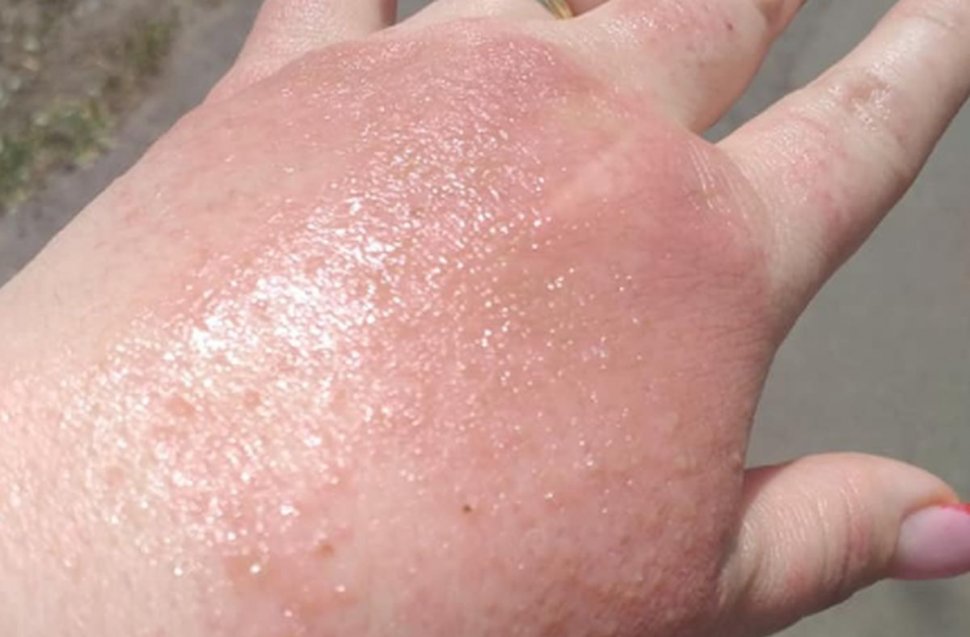 O femeie din Brăila s-a ales cu arsuri pe mâini după ce a folosit dezinfectant la un supermarket