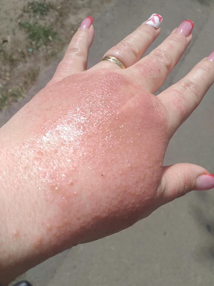 O femeie din Brăila s-a ales cu arsuri pe mâini după ce a folosit dezinfectant la un supermarket 655764