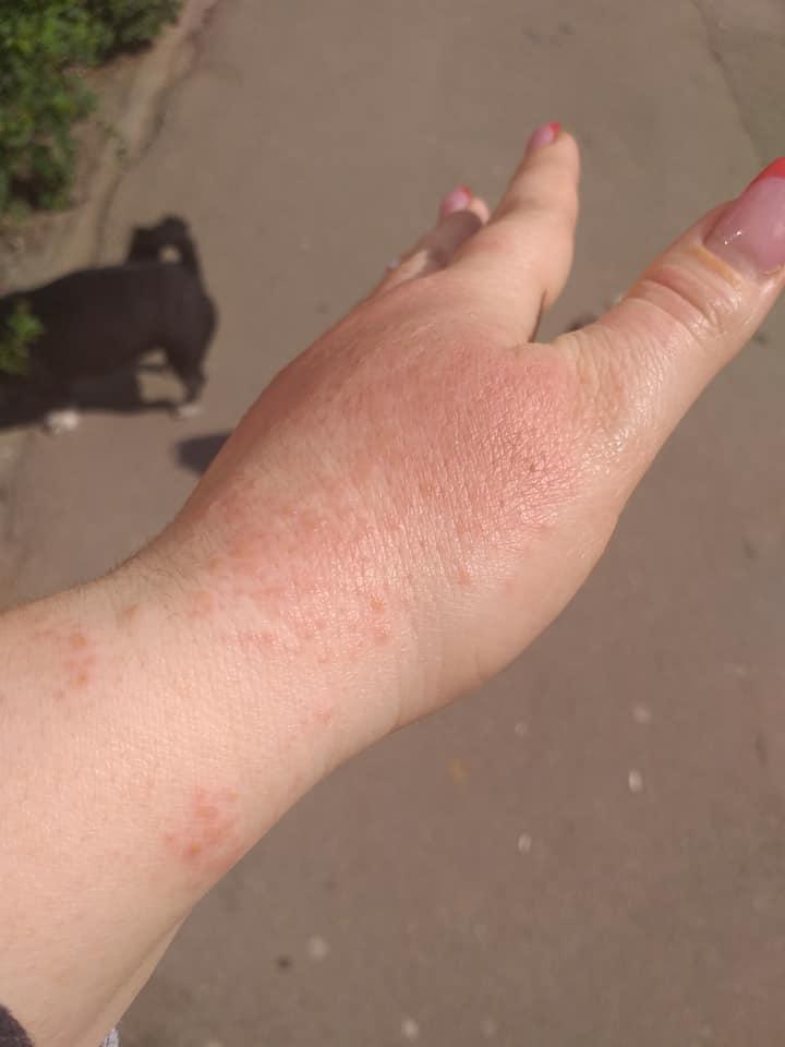 O femeie din Brăila s-a ales cu arsuri pe mâini după ce a folosit dezinfectant la un supermarket 655765