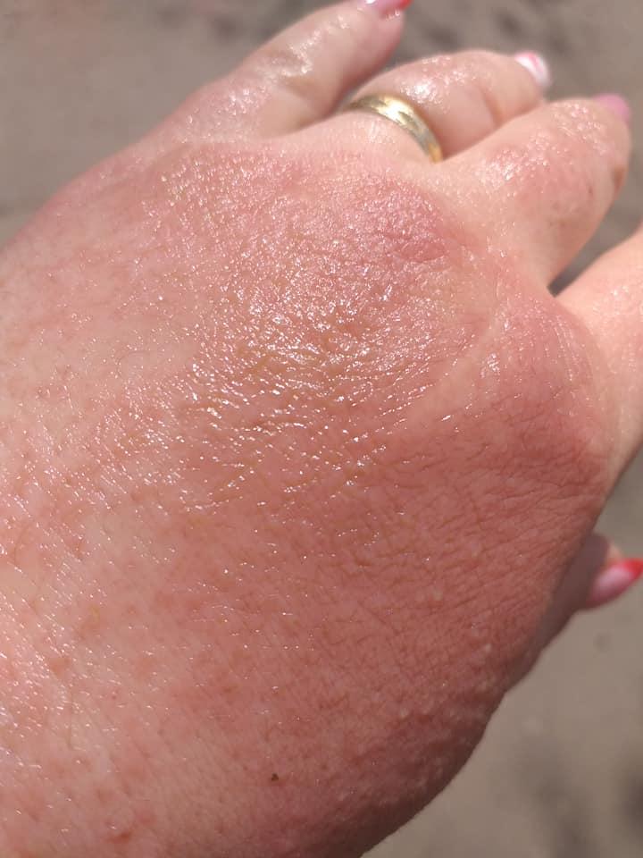 O femeie din Brăila s-a ales cu arsuri pe mâini după ce a folosit dezinfectant la un supermarket 655766