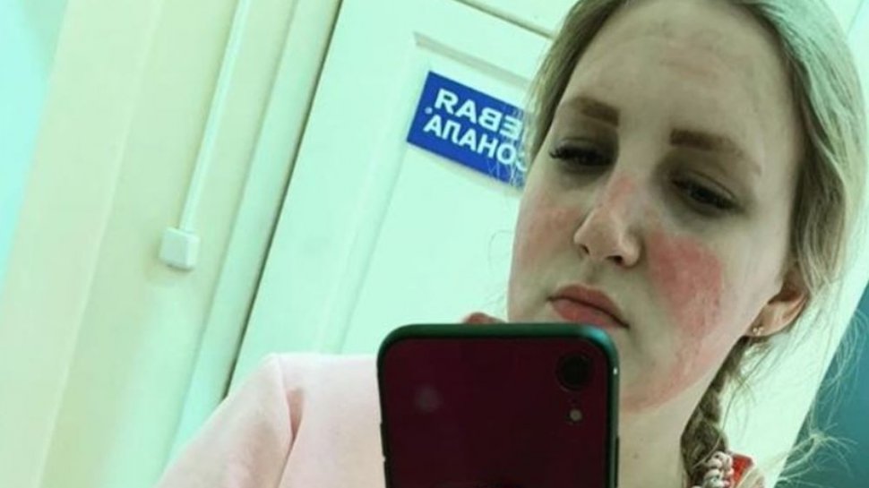 O asistentă medicală s-a ales cu arsuri pe față din cauza măștii: „Nu faceți această greșeală”