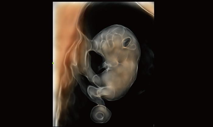 Care este diferenta dintre ecografia 2D, 3D si 4D? 679210